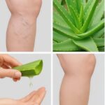 Aloe Vera: El Remedio Natural para las Venas Varicosas